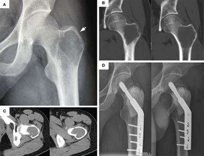 Comparative Analysis of Two Surgical Treatment Options for Giant Cell Tumor of the Proximal Femur: Extended Curettage and Segmental Resection